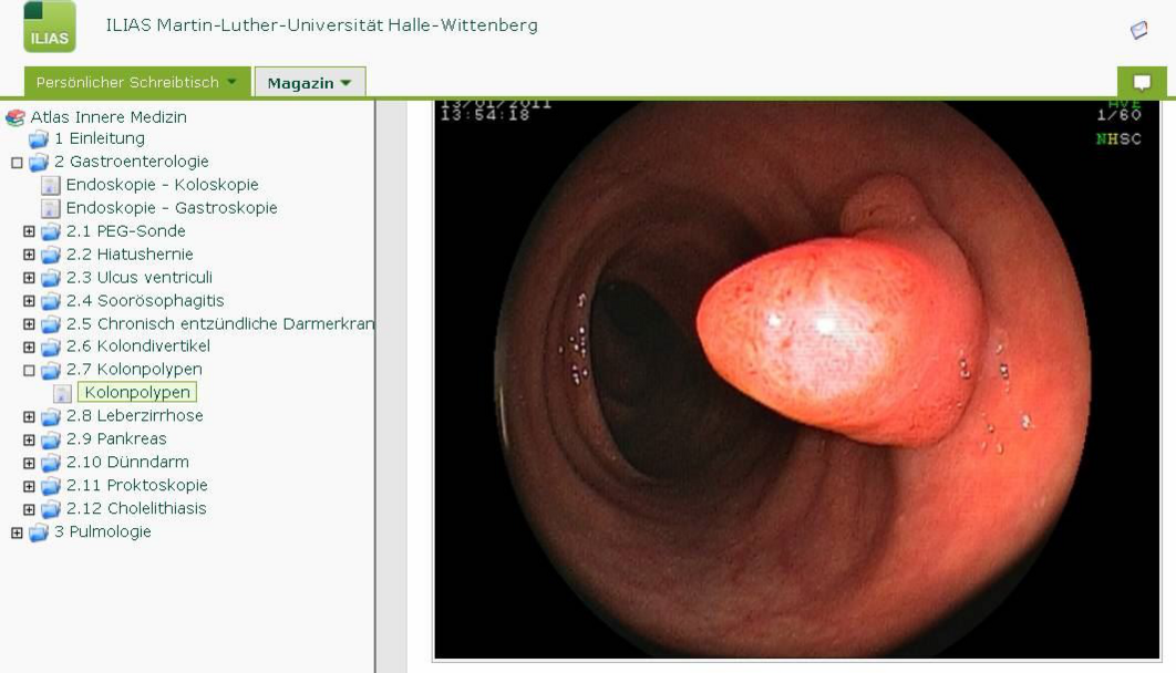 Screenshot ILIAS-System Gastroenterologie: Aufnahme eines Kolonpolypen