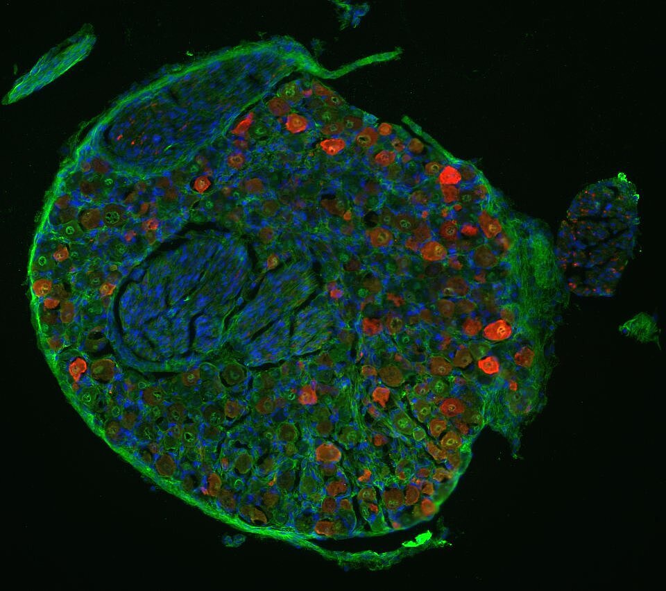 Spinalganglion mit Neuronen, die AAV aufgenommen haben