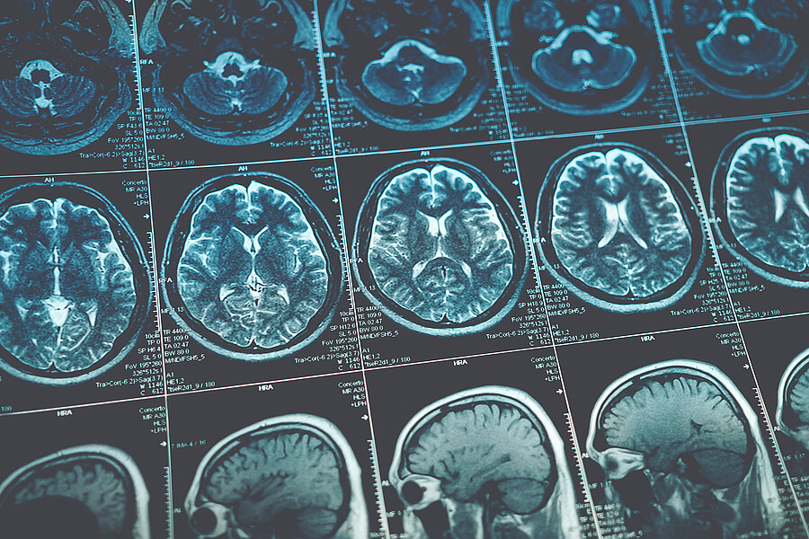 Fortschritte bei der Alzheimer-Früherkennung  