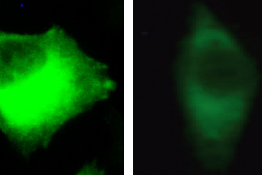 University Medicine Halle (Saale) involved in an international consortium investigating the development of the rare muscle disease GNE myopathy  