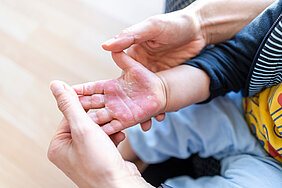 Zwei Hände halten die Hand eines Kindes. Die Handfläche des Kindes weist eine Brandverletzung oder Verbrühung auf.