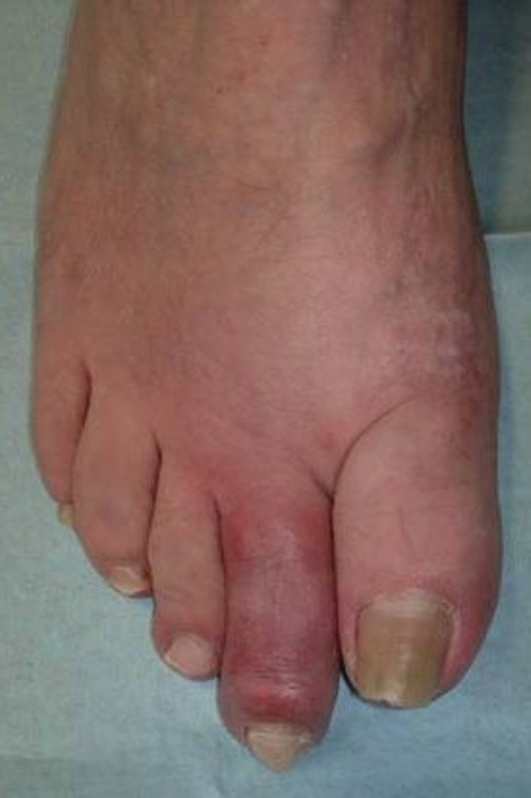 Arthritis urica (Gicht) Department für Orthopädie, Unfall und