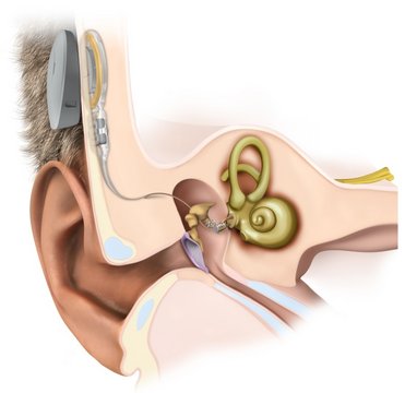 Implantierbare Hörgeräte
